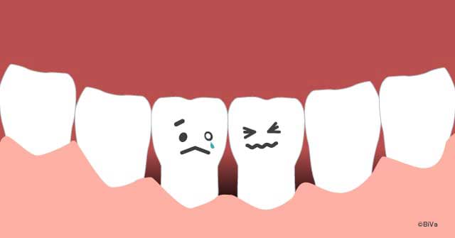 歯茎下がりは老けて見える！ウワサの歯茎を再生させる移植手術とは？